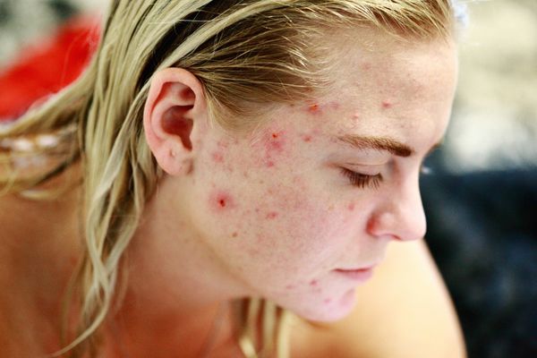 blond woman with acne