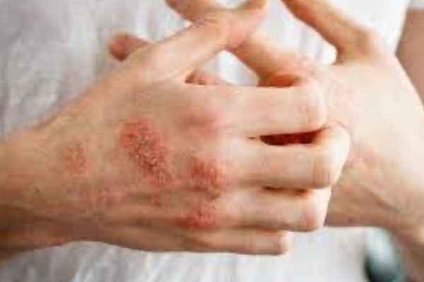eczema breakout on a man's hands